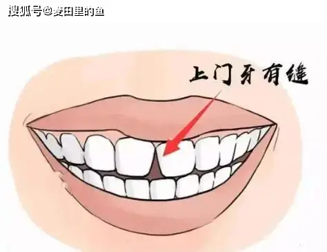 牙齒縫隙大有什么好的方法解決？